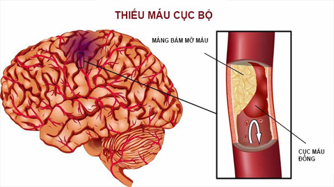 Cục máu đông hình thành ở não có thể gây đột quỵ