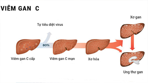 Uống nhiều rượu làm bệnh Viêm gan C trầm trọng hơn. Ảnh minh họa