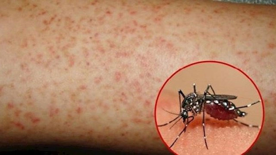 Sốt xuất huyết Dengue là một trong những bệnh truyền nhiễm phổ biến ở nước ta.