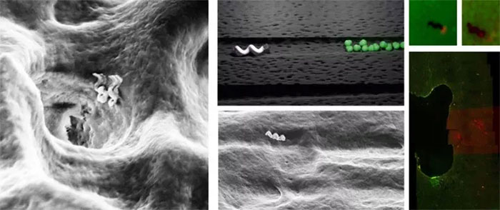 Trái: Nanobots đi vào ống tủy răng. Hình giữa và bên dưới nói: Hình ảnh nanobot di chuyển qua ống tủy răng để đến khu vực vi khuẩn. Phải: Hình ảnh kính hiển vi của sức nóng cục bộ từ nanobot có thể tiêu diệt vi khuẩn như thế nào. Vi khuẩn sống có màu xanh lá cây và vi khuẩn chết có màu đỏ. Dưới cùng bên phải hiển thị vị trí điều trị được thực hiện trên răng người