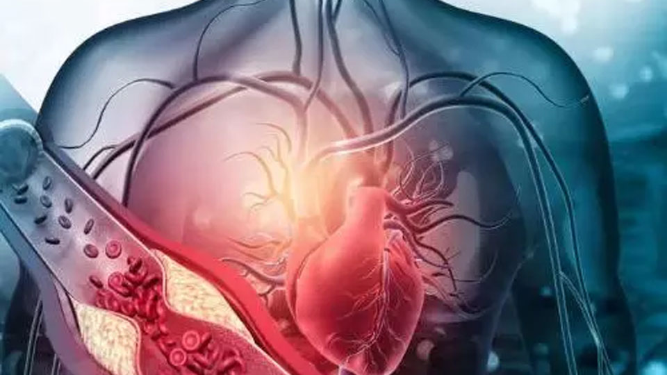 Cholesterol cao làm tăng nguy cơ mắc các bệnh về tim.